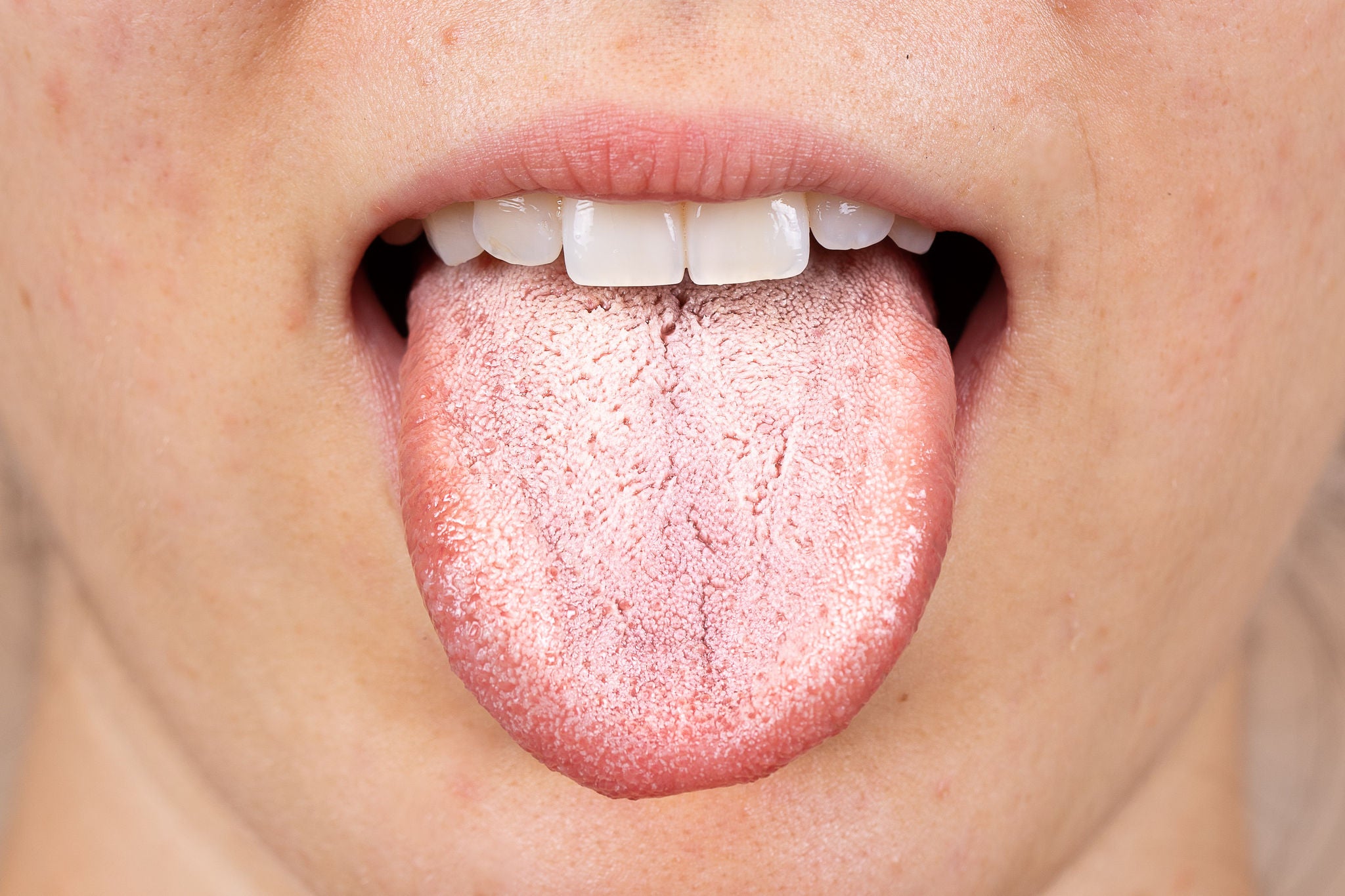 A close up view on the white furry tongue of a young Caucasian girl. A common symptom of a candida albicans yeast infection., A close up view on the white furry tongue of a young Caucasian g