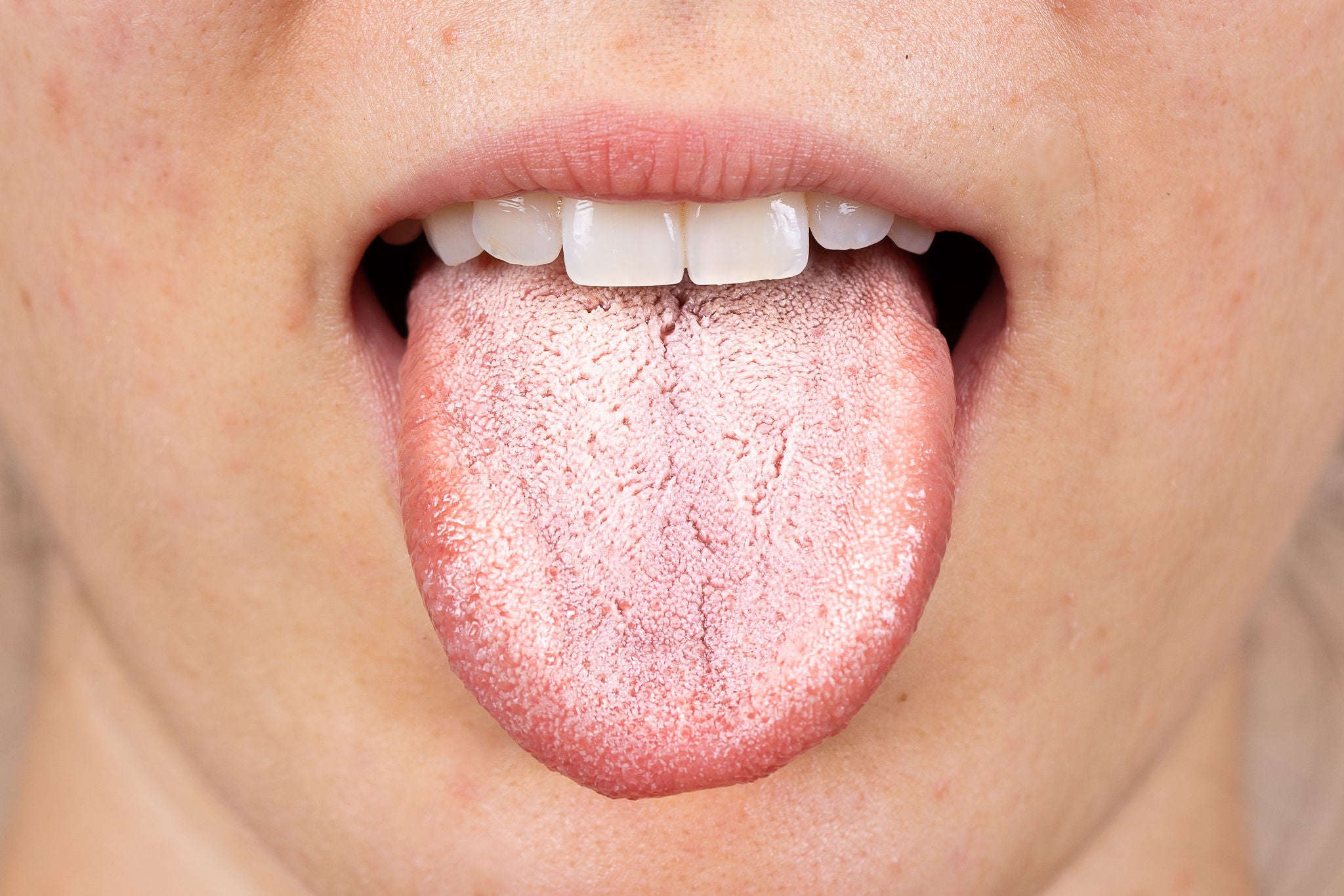 A close up view on the white furry tongue of a young Caucasian girl. A common symptom of a candida albicans yeast infection.