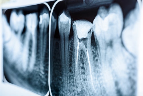 Próchnica korzenia zęba – jak skutecznie zapobiec?