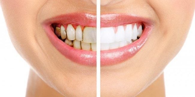 Comparison between stained and whitened teeth