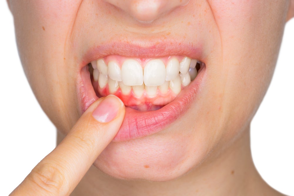Woman with inflamed gums shutterstock_617617109