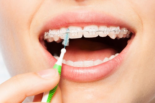 5 zasad pielęgnacji jamy ustnej przy aparacie ortodontycznym