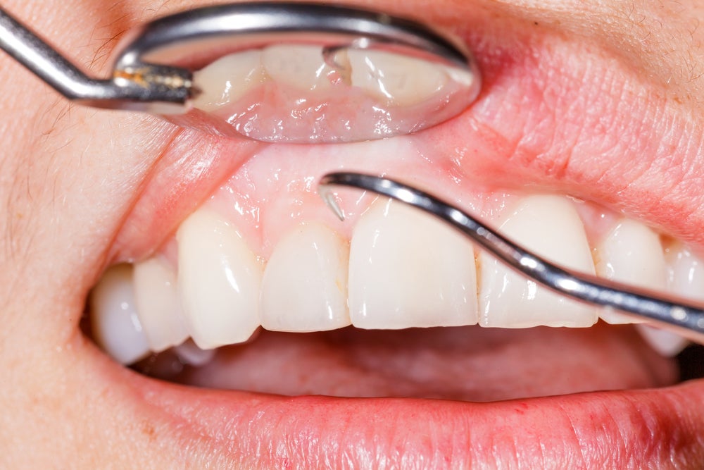 Ropień zęba a przebicie - co zrobić żeby ropień zęba pękł?