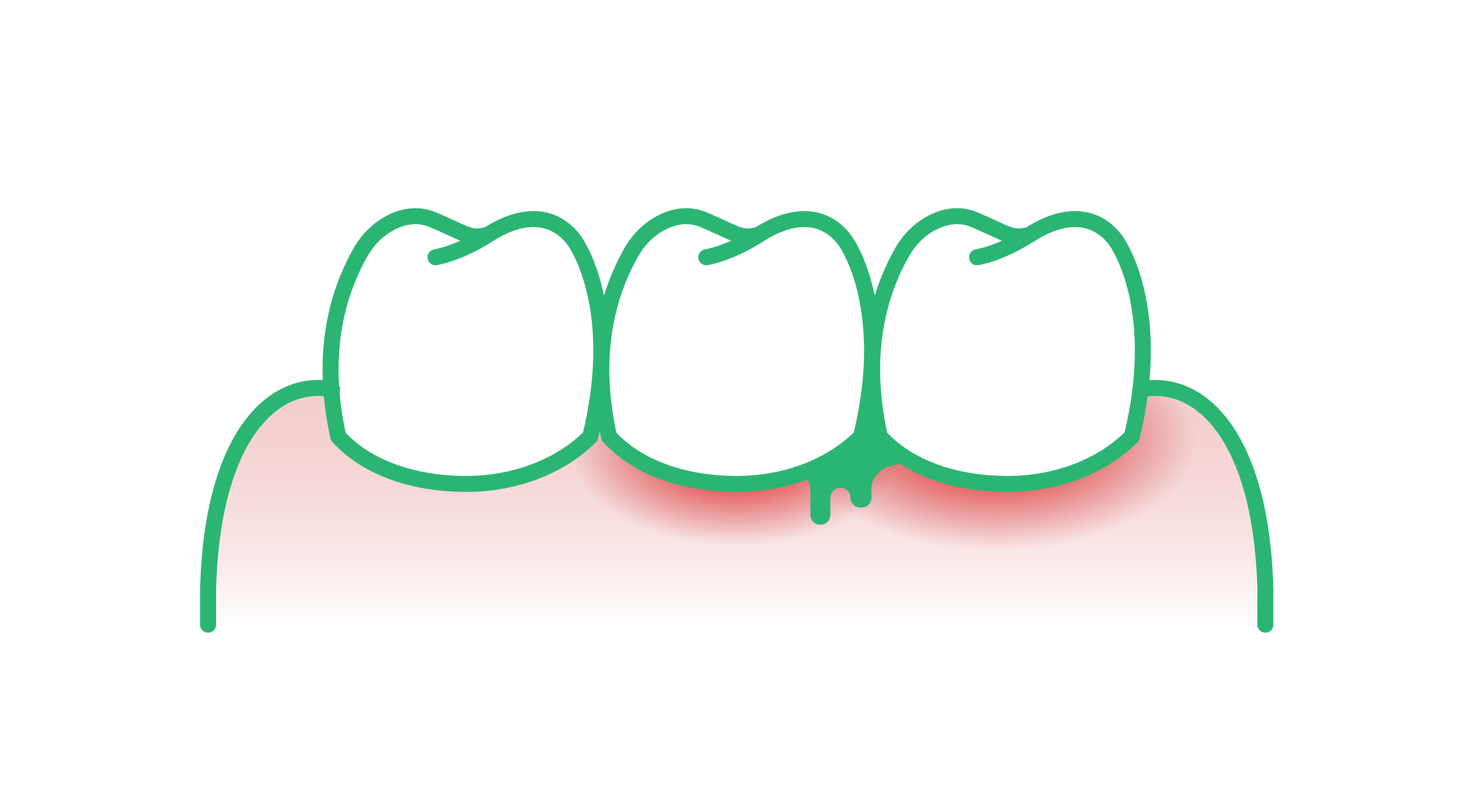 Zahnfleischentzündung am Zahnfleischrand