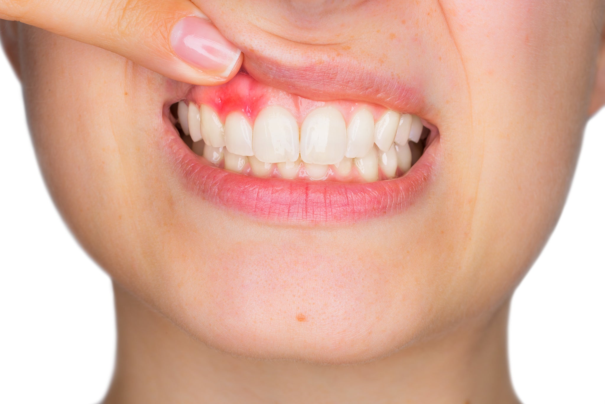 Empfindliches Zahnfleisch, Gingivitis und Zahnfleischerkrankung