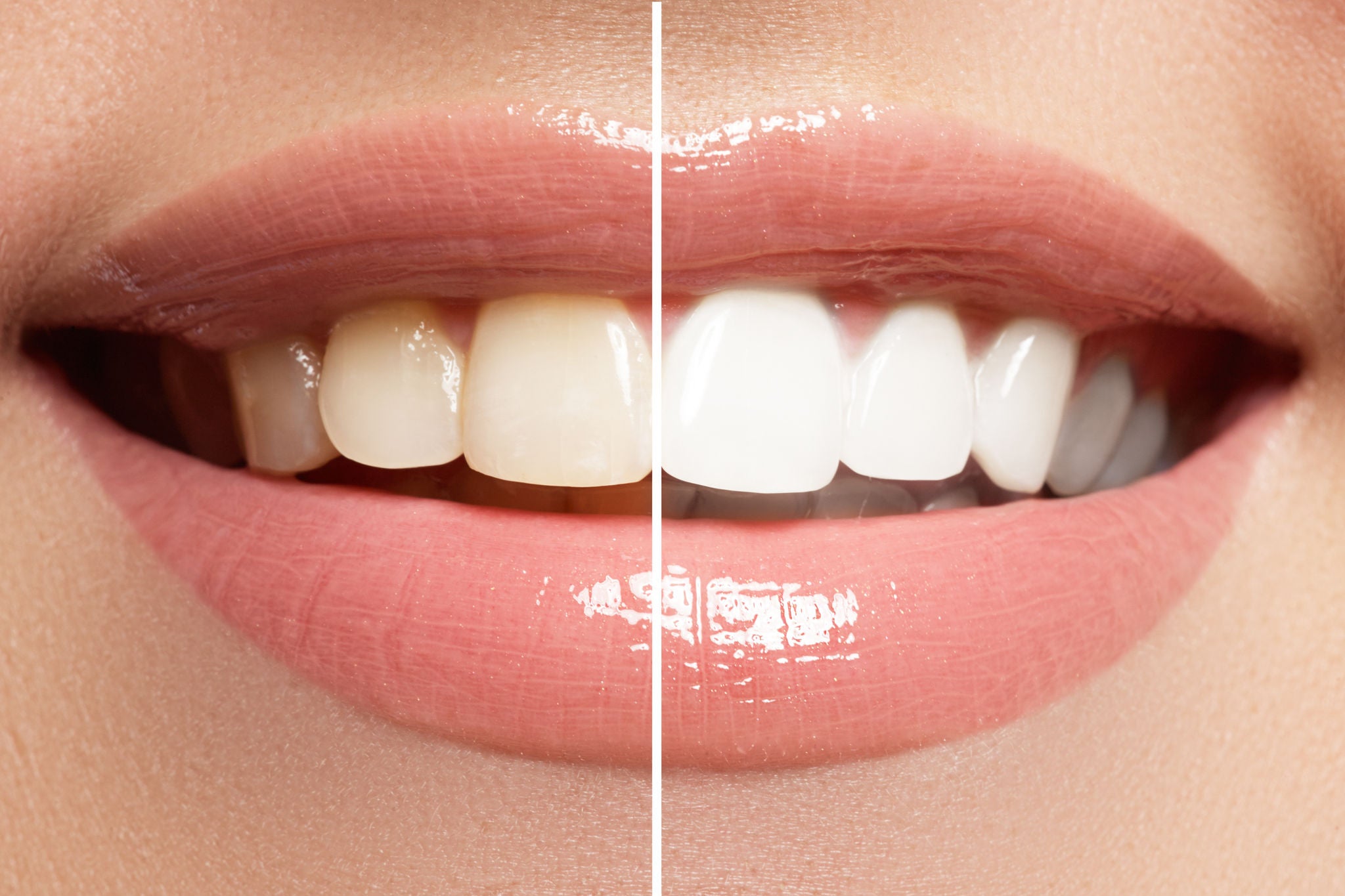 De wie, wat, waar en waarom van tanden bleken