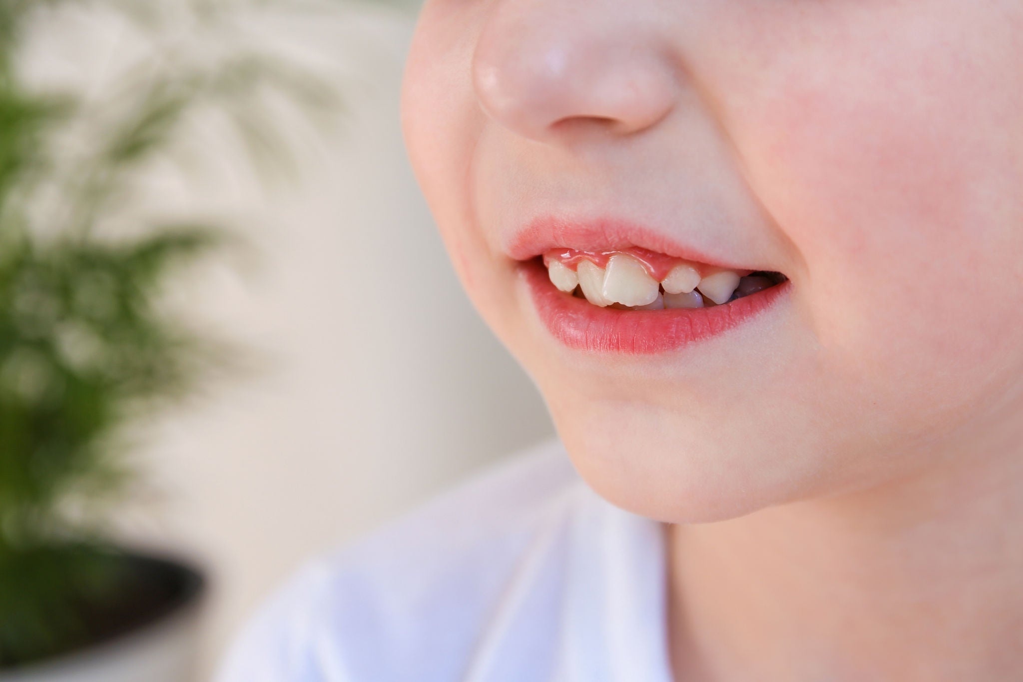 Child has crooked teeth. The concept of crowding of molars.