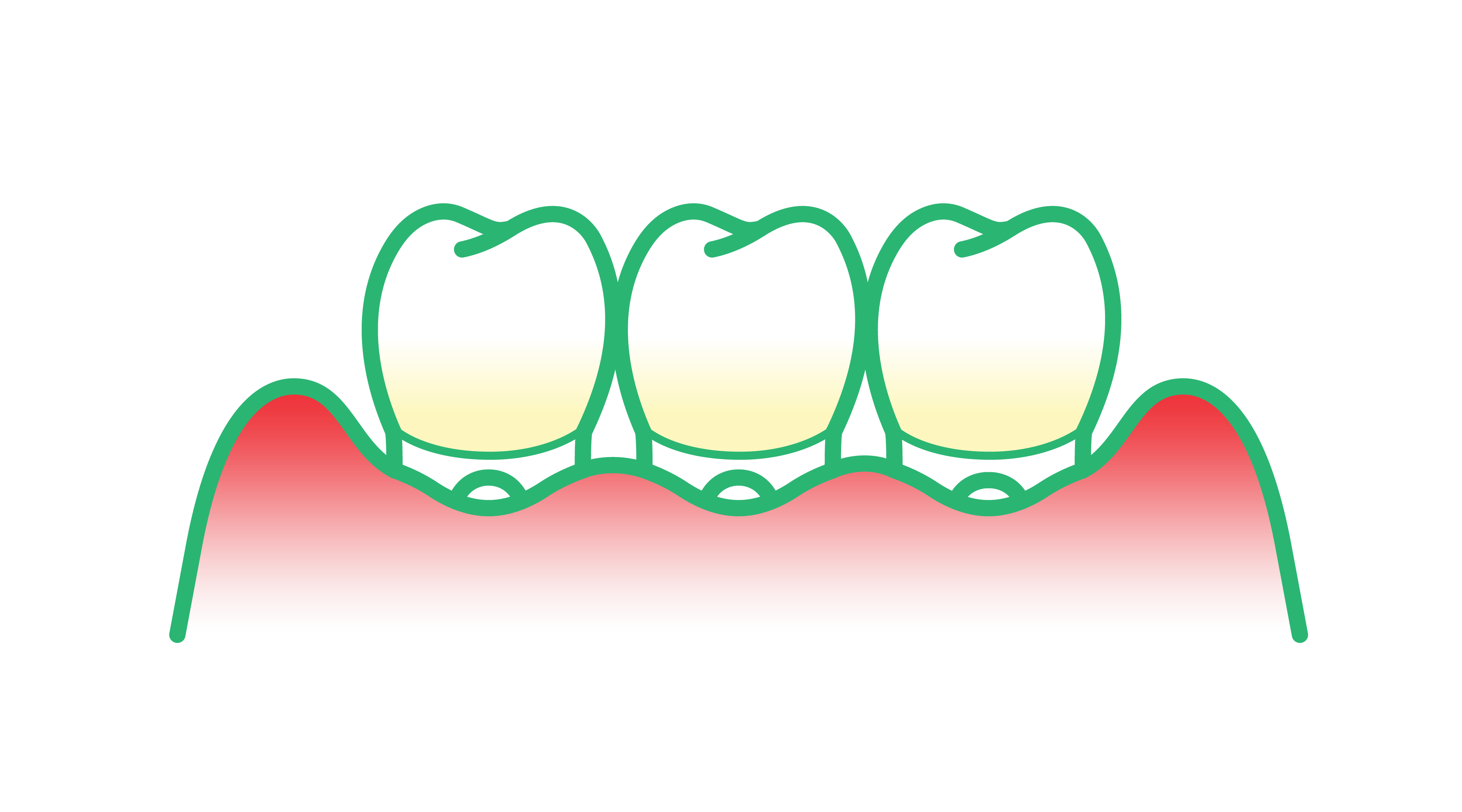 Ilustración de encías retraídas por enfermedad periodontal provocada por el tabaco