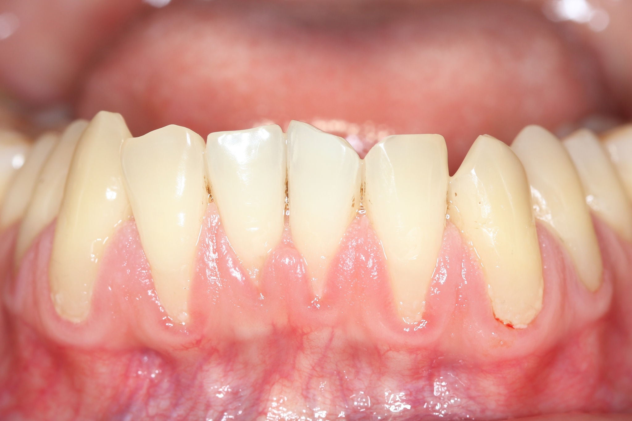 Nadwrażliwość zębów – objawy, leczenie, przyczyny