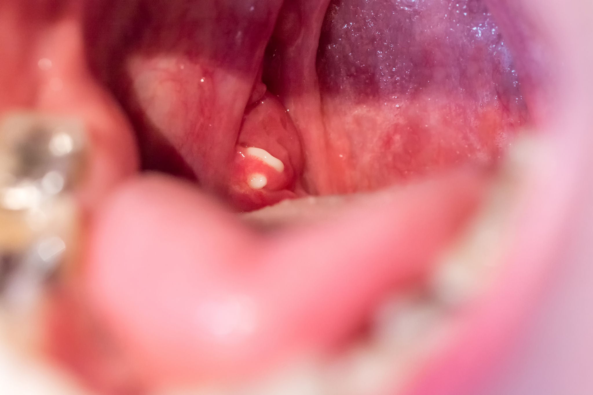 Close-up image of the back of a person’s throat showing small white or yellowish tonsil stones lodged in the crevices of the tonsils.