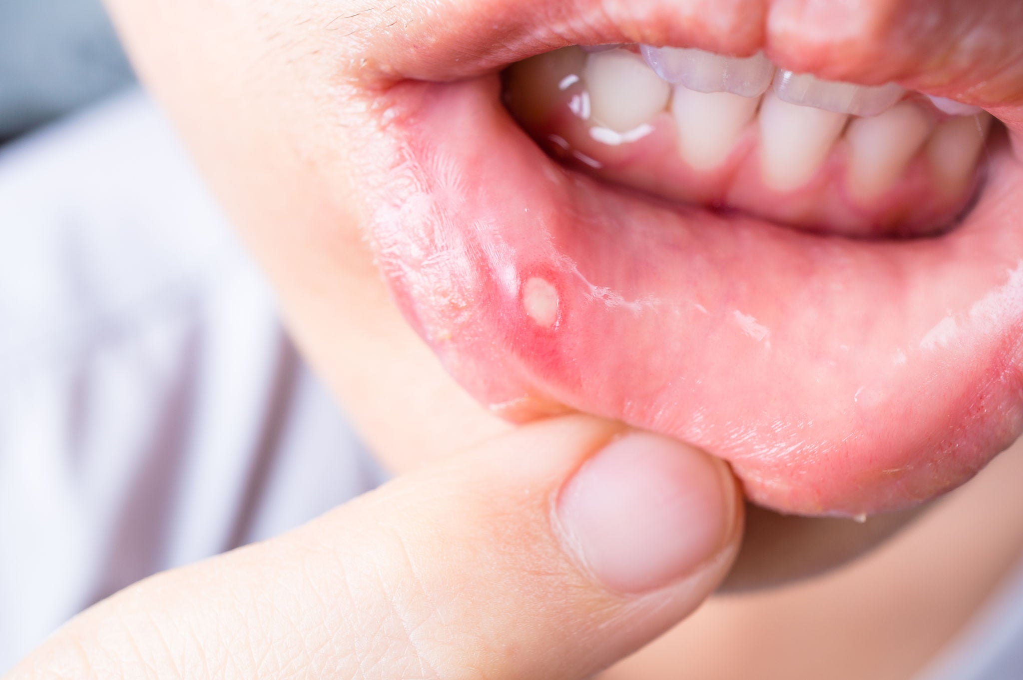 Close up of Asian woman with aphtha on lip