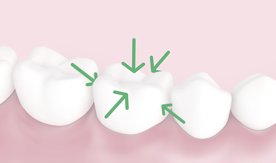 Illu-How-to-get-STEP-2-tooth-5-surfaces