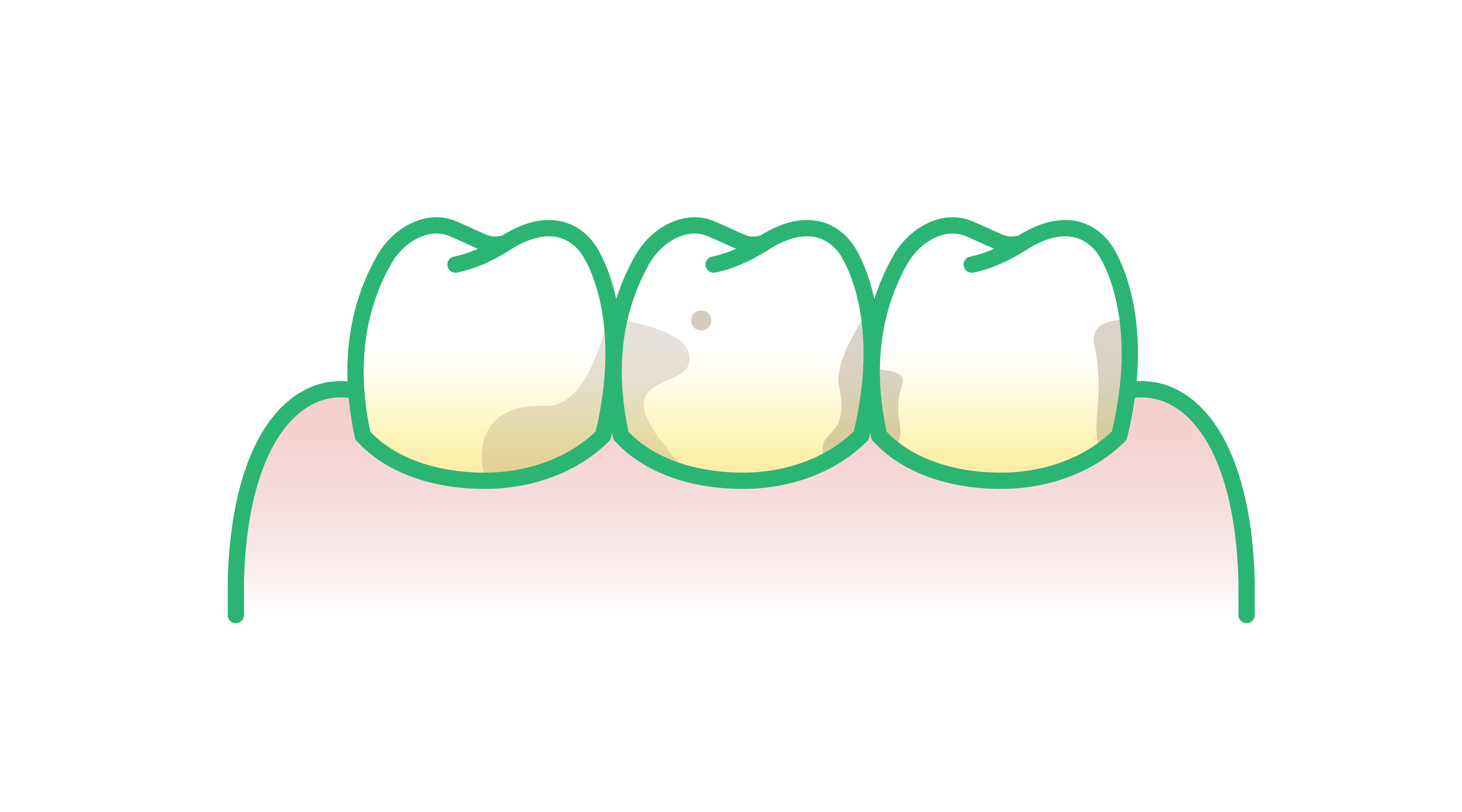 Abbildung von Zahnbelag oder Zahnstein
