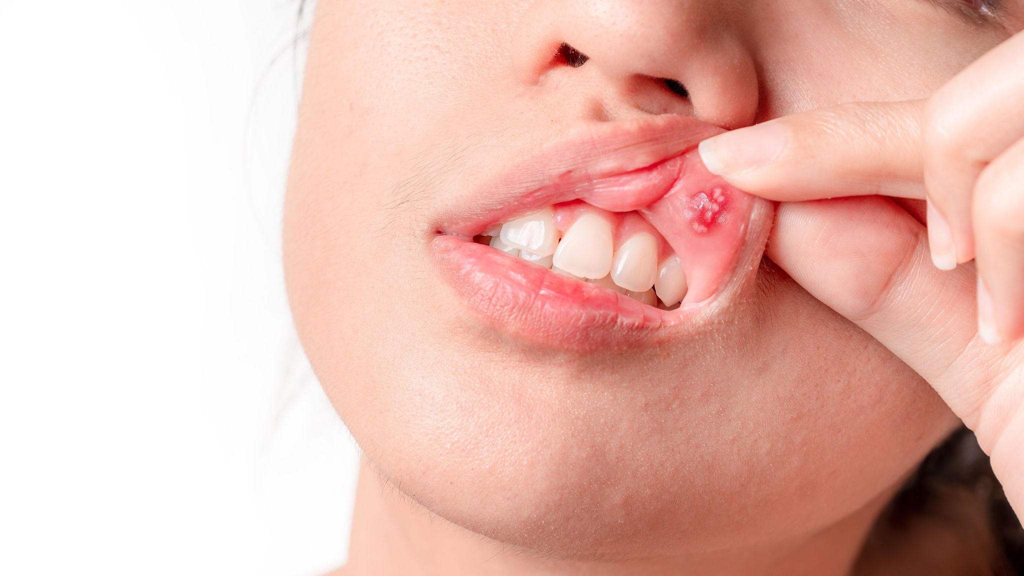 Asian women have aphthous ulcers on mouth on white background, selective focus.