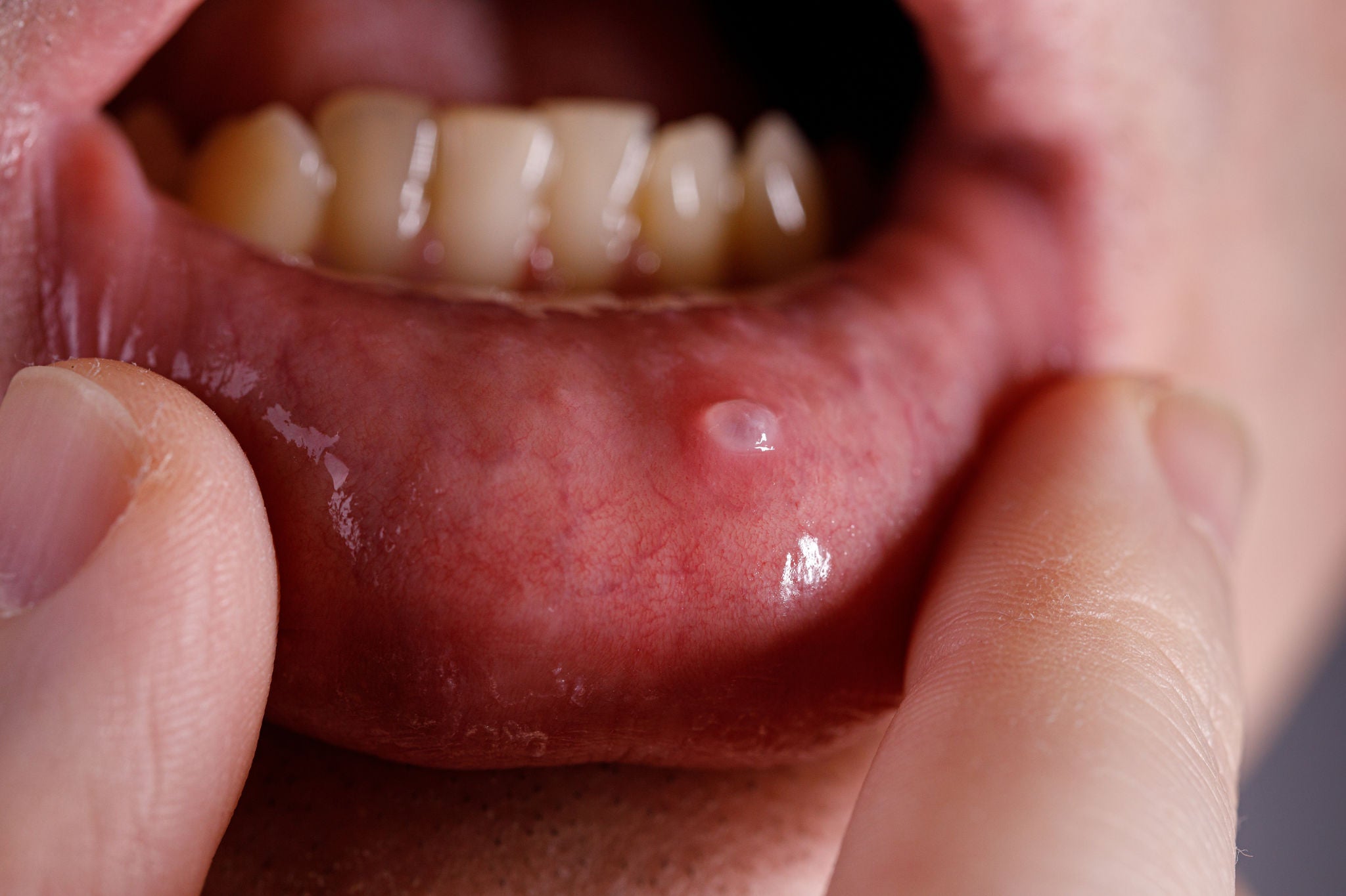 Mucocele – hvad er det, og hvordan påvirker det mundsundheden?