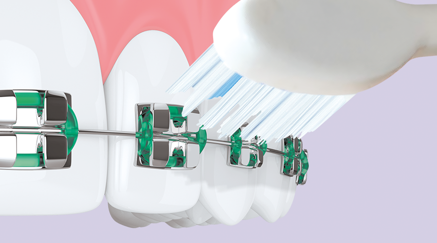 cepillo GUM ORTHO contra brackets
