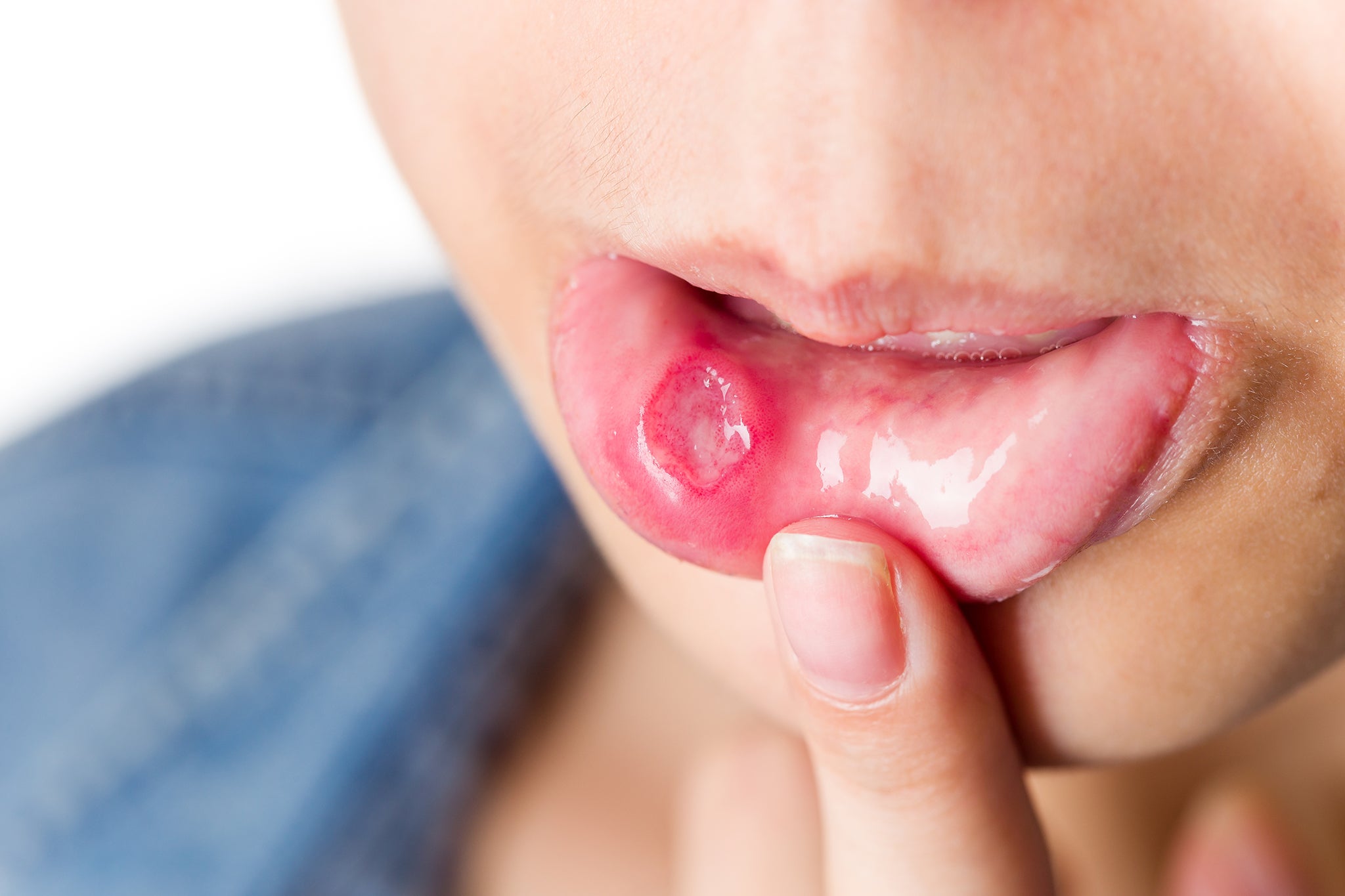 Co to jest afta i dlaczego powstaje w jamie ustnej?