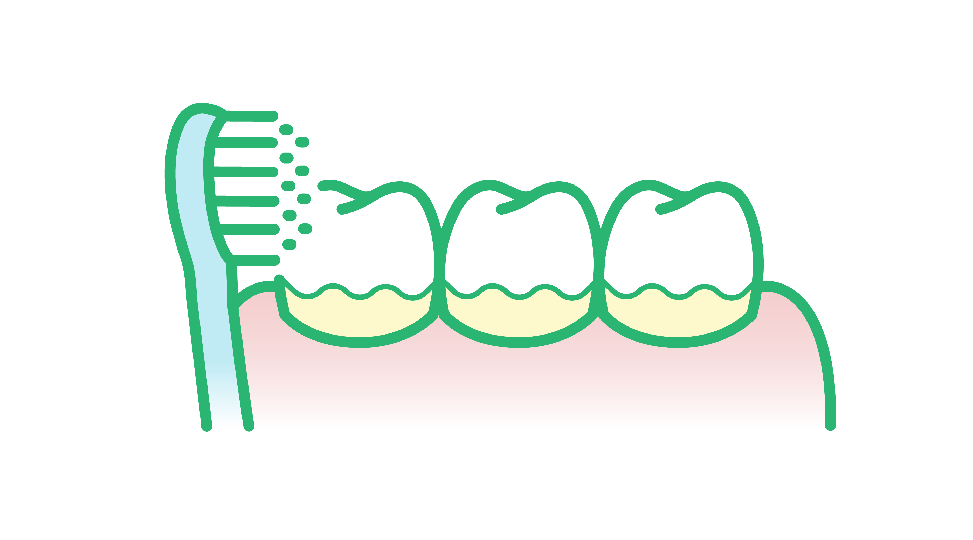 Illu-How-to-Persistent-plaque