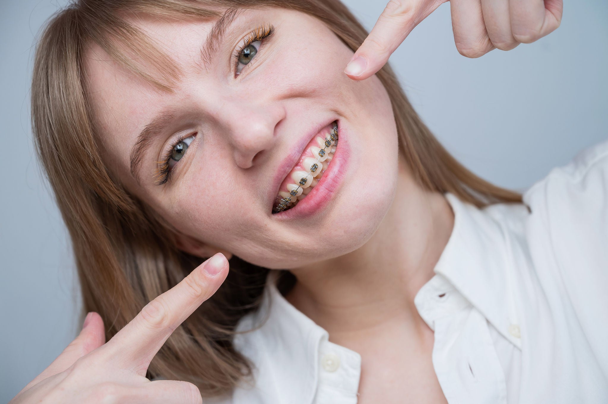 A beautiful red-haired girl smiles and points to the braces. Young woman corrects bite with orthodontic appliance.