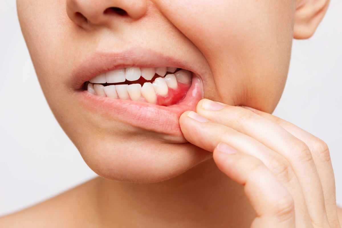 Gingivite : comment soigner une gingivite ?