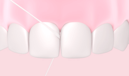 tandtråd mellan de främre tänderna