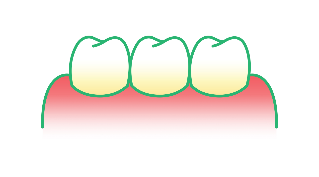 Illustration einer Zahnfleischentzündung