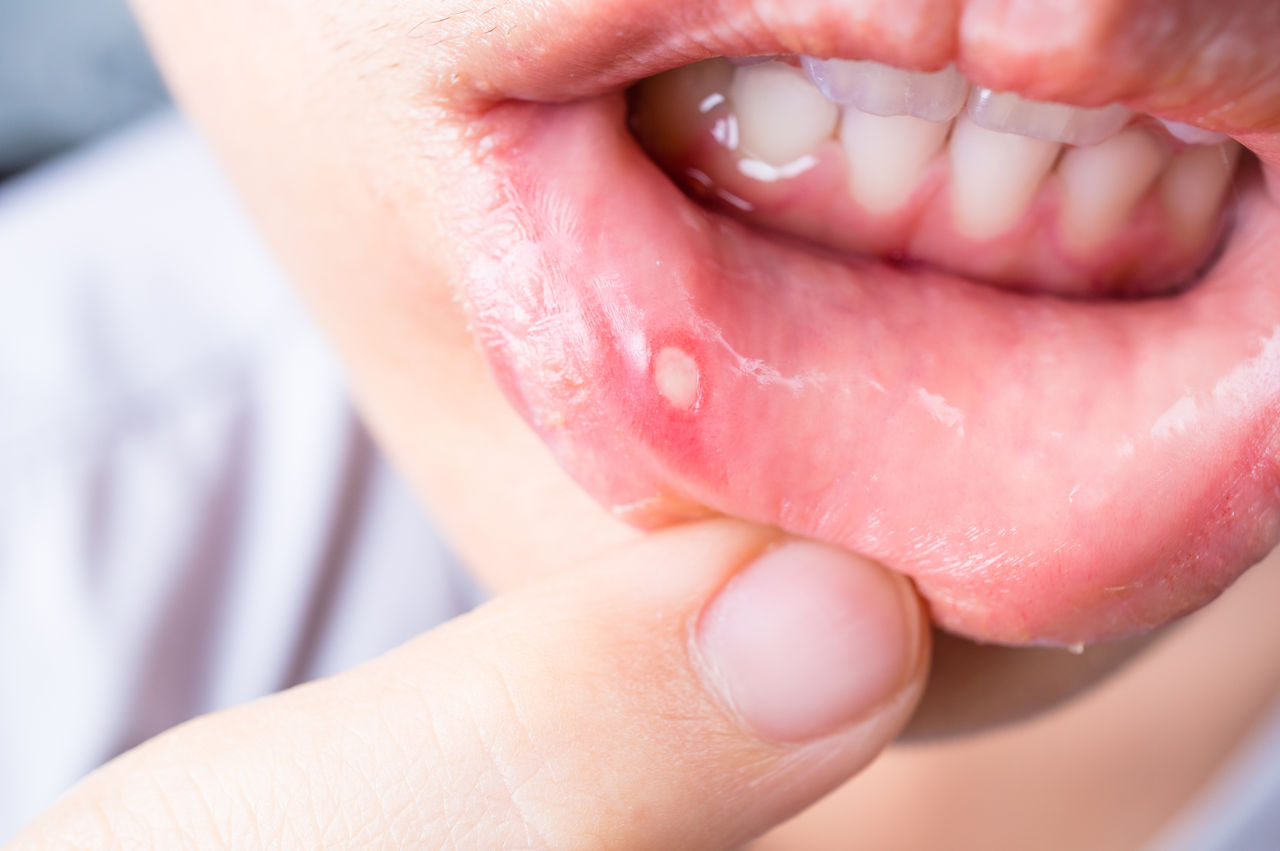 Woman pointing at a mouth ulcer