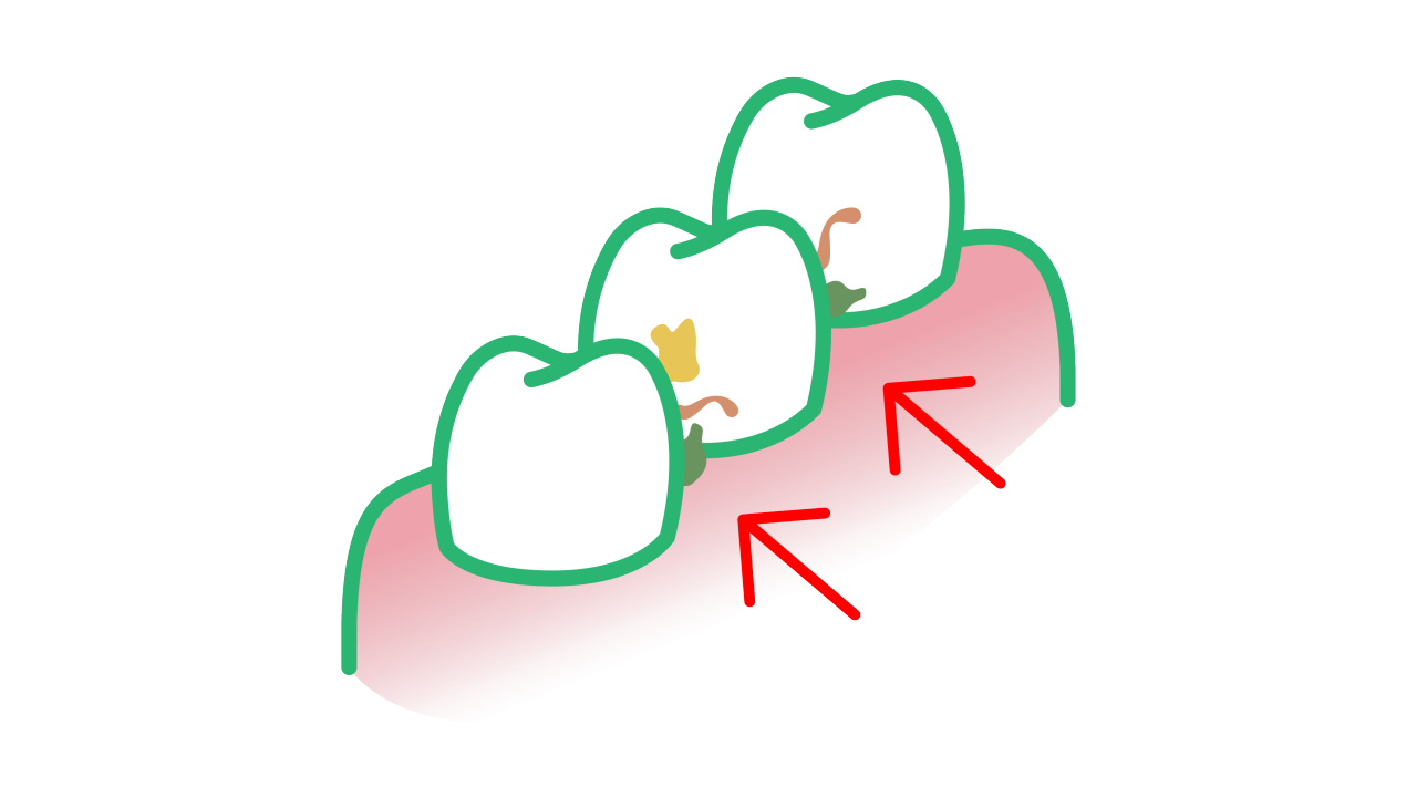 GUM Trav-ler food debris plaque between teeth