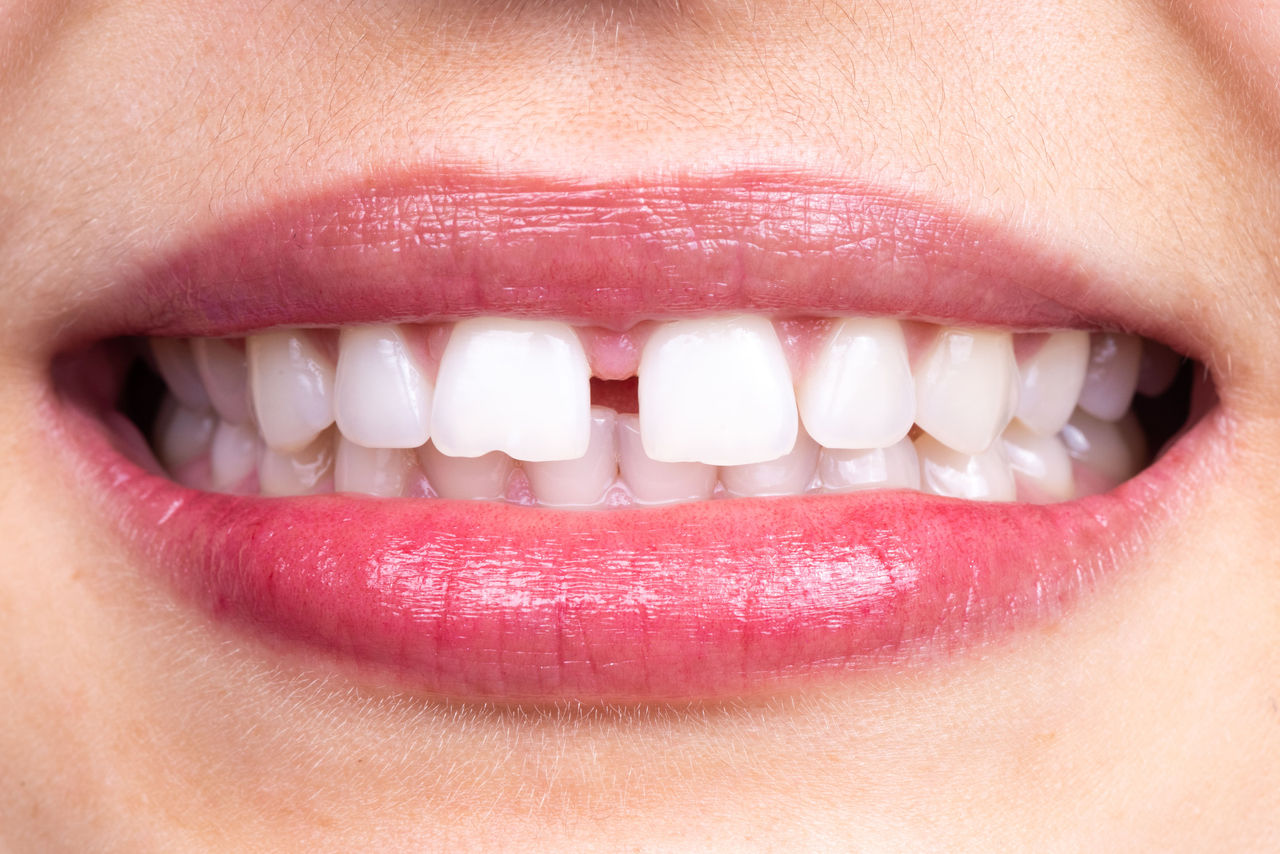 Diastema – mellemrum mellem tænderne
