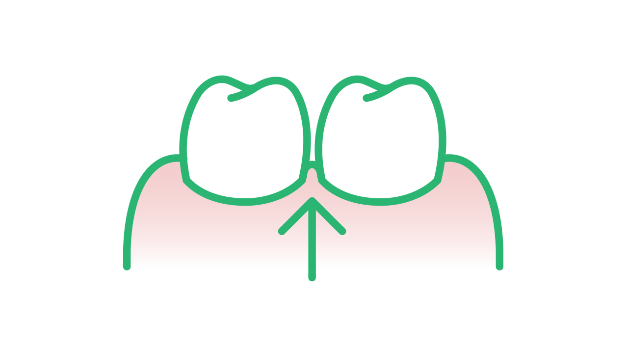 Illu-How-to-Interdental-papilla