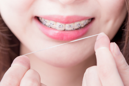 Cómo usar hilo dental con ortodoncia: 4 maneras fáciles