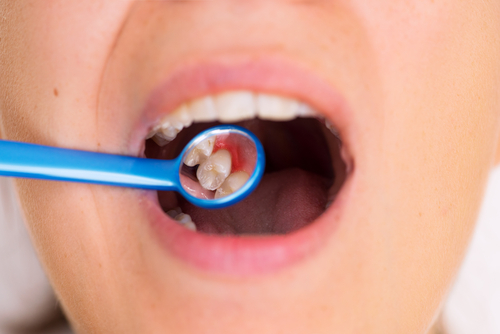 Denti storti: sintomi, cause e rimedi