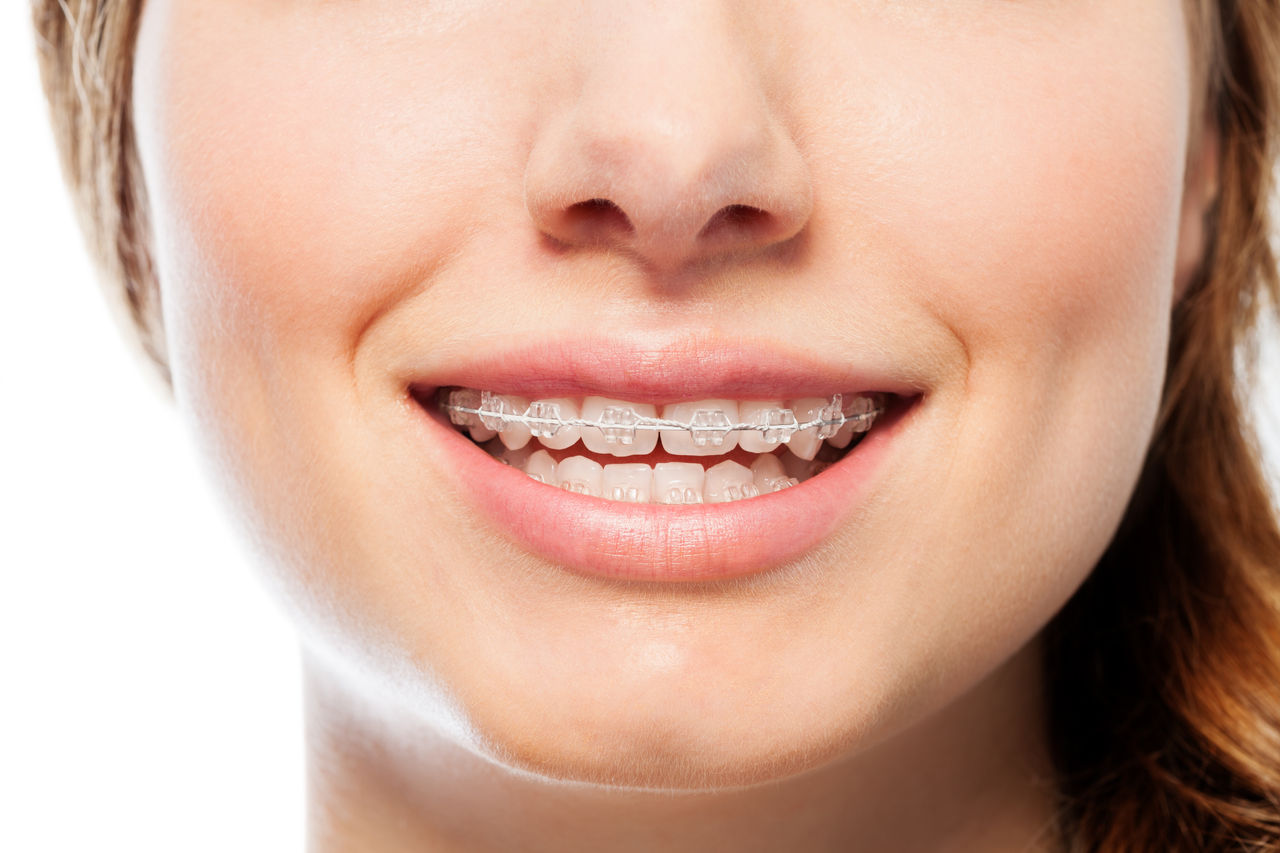 Dentifricio per apparecchio ortodontico