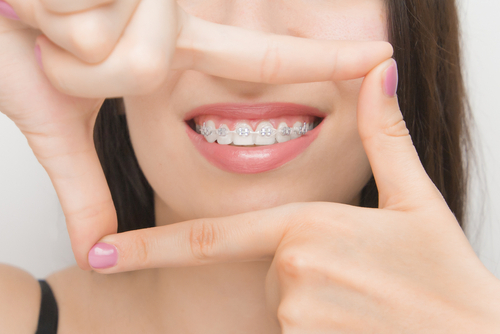 Woman with braces smile