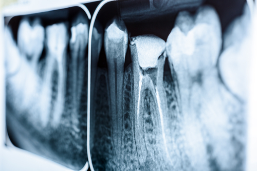Obturation-of-root-canal-systems-on-teeth-x-ray.jpg