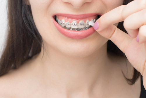 Wosk ortodontyczny – czym jest, po co go używać i jak nakładać? 