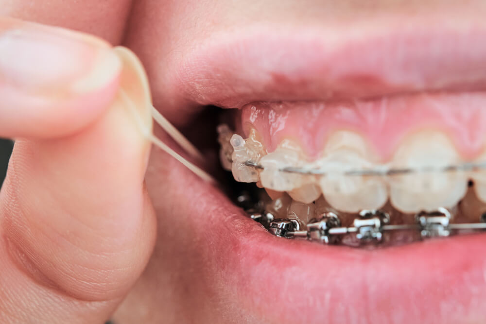 Wyciągi ortodontyczne – co to jest i w jakim celu się je stosuje?